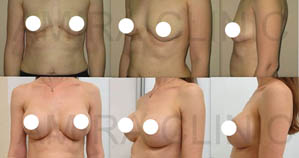 Увеличение груди фото 1