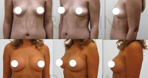 Увеличение груди фото 6