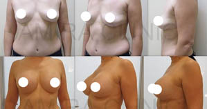 Увеличение груди фото 11
