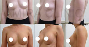 Увеличение груди фото 28