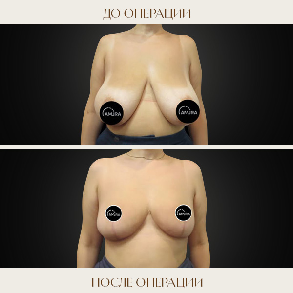 reduc 5