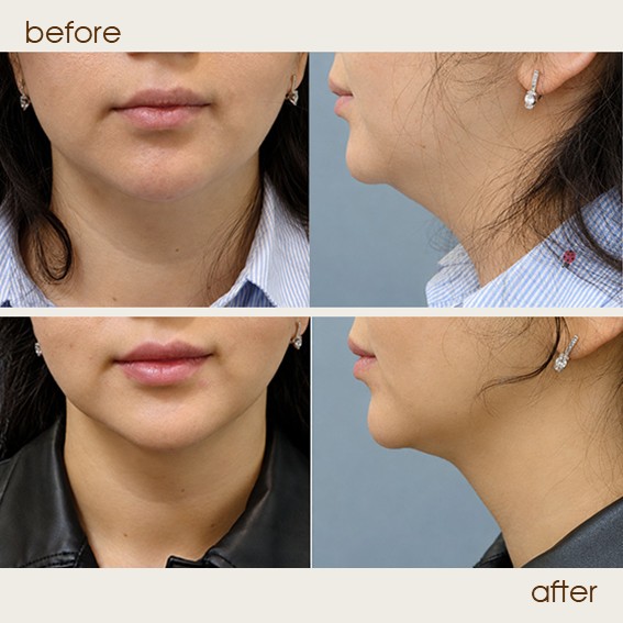 liposuction 1