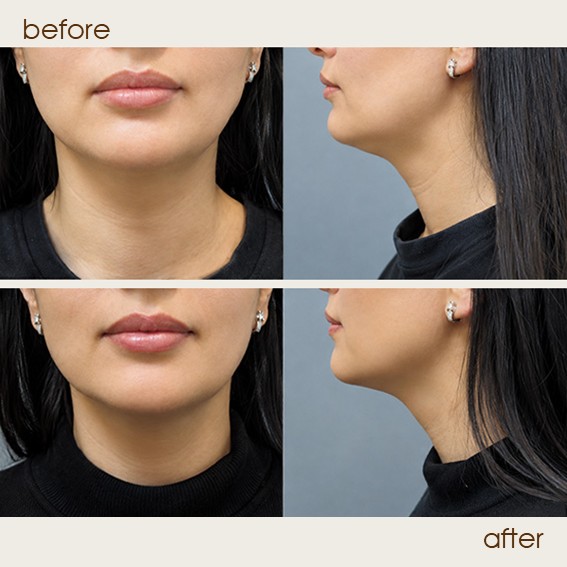 liposuction 2