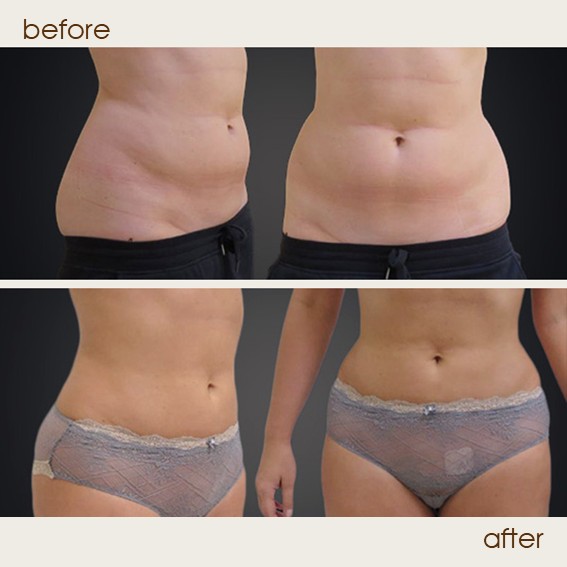 liposuction 3