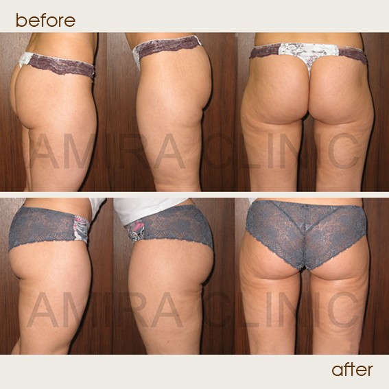 liposuction 4